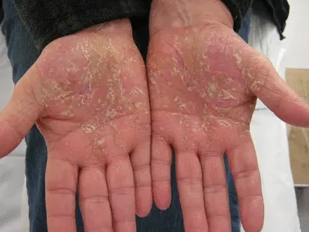 Psoriasis • Palmar