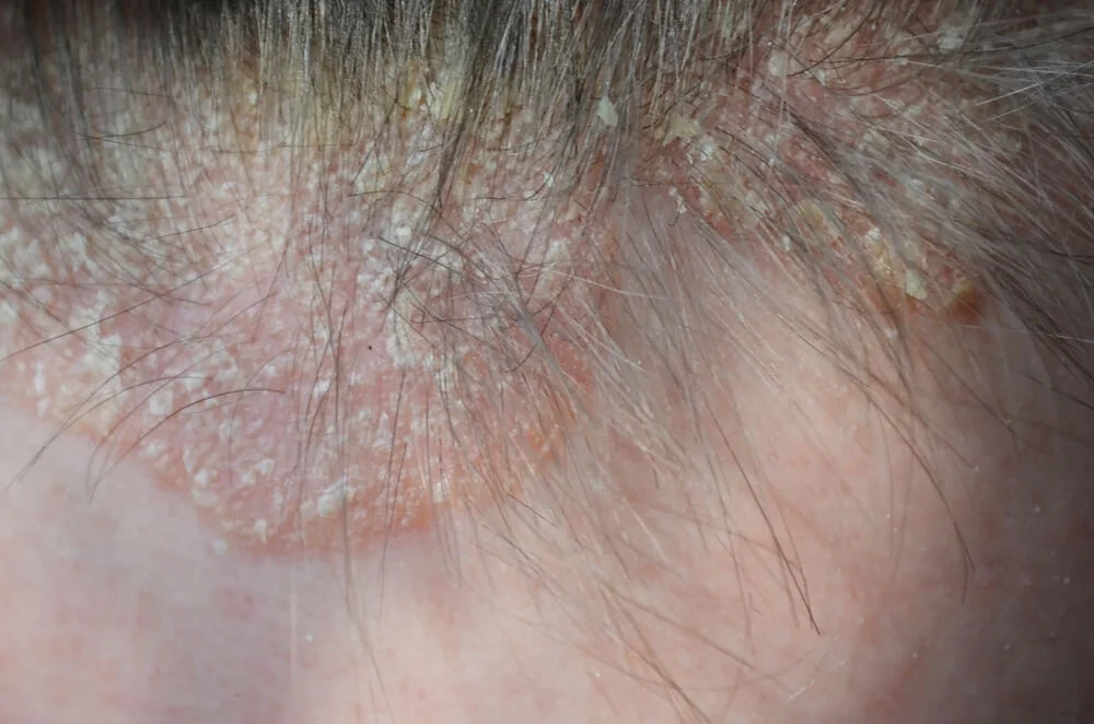 Psoriasis • Cuero Cabelludo