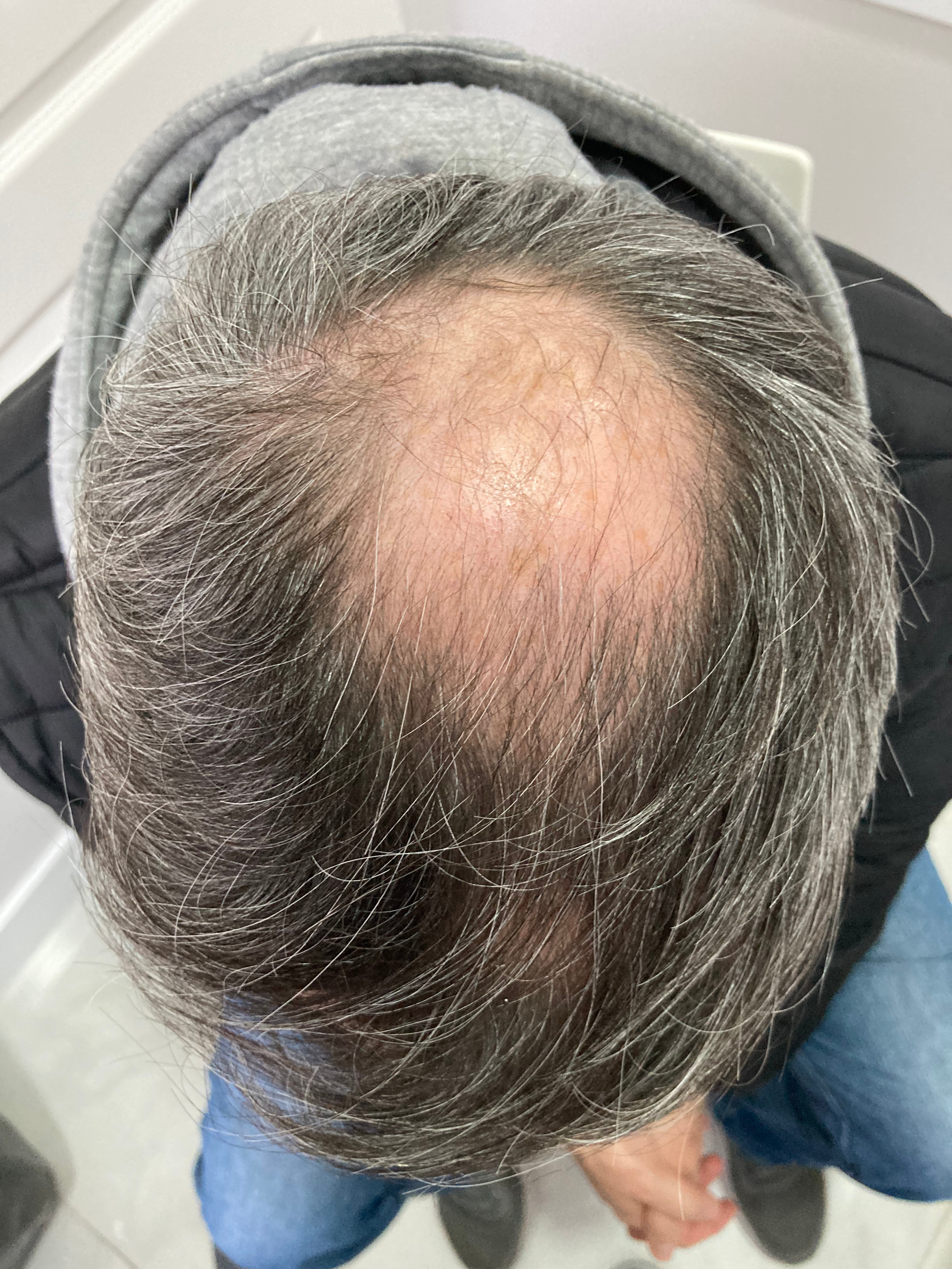 Alopecoa Androgenética • Pretratamiento