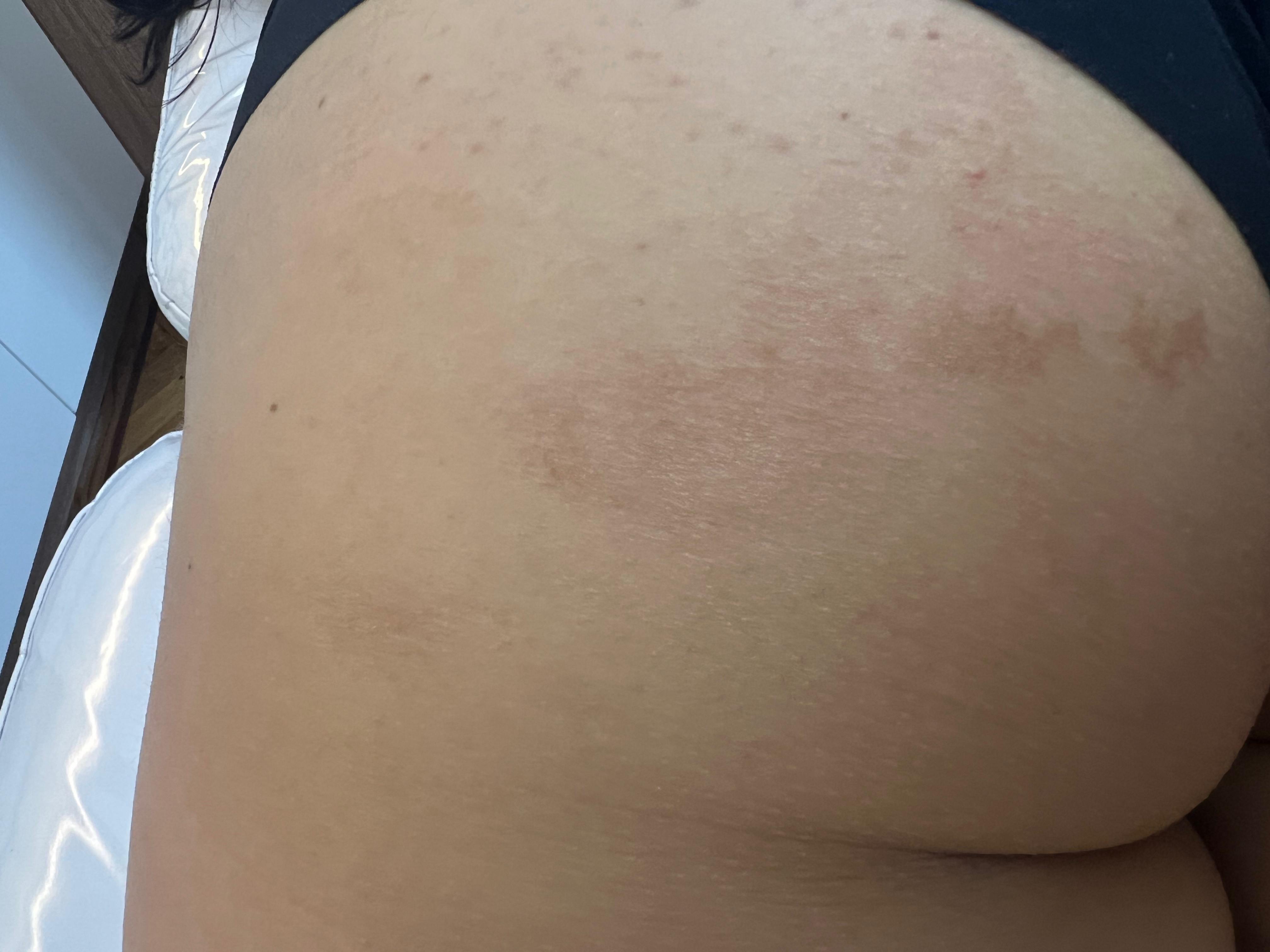 Eccema