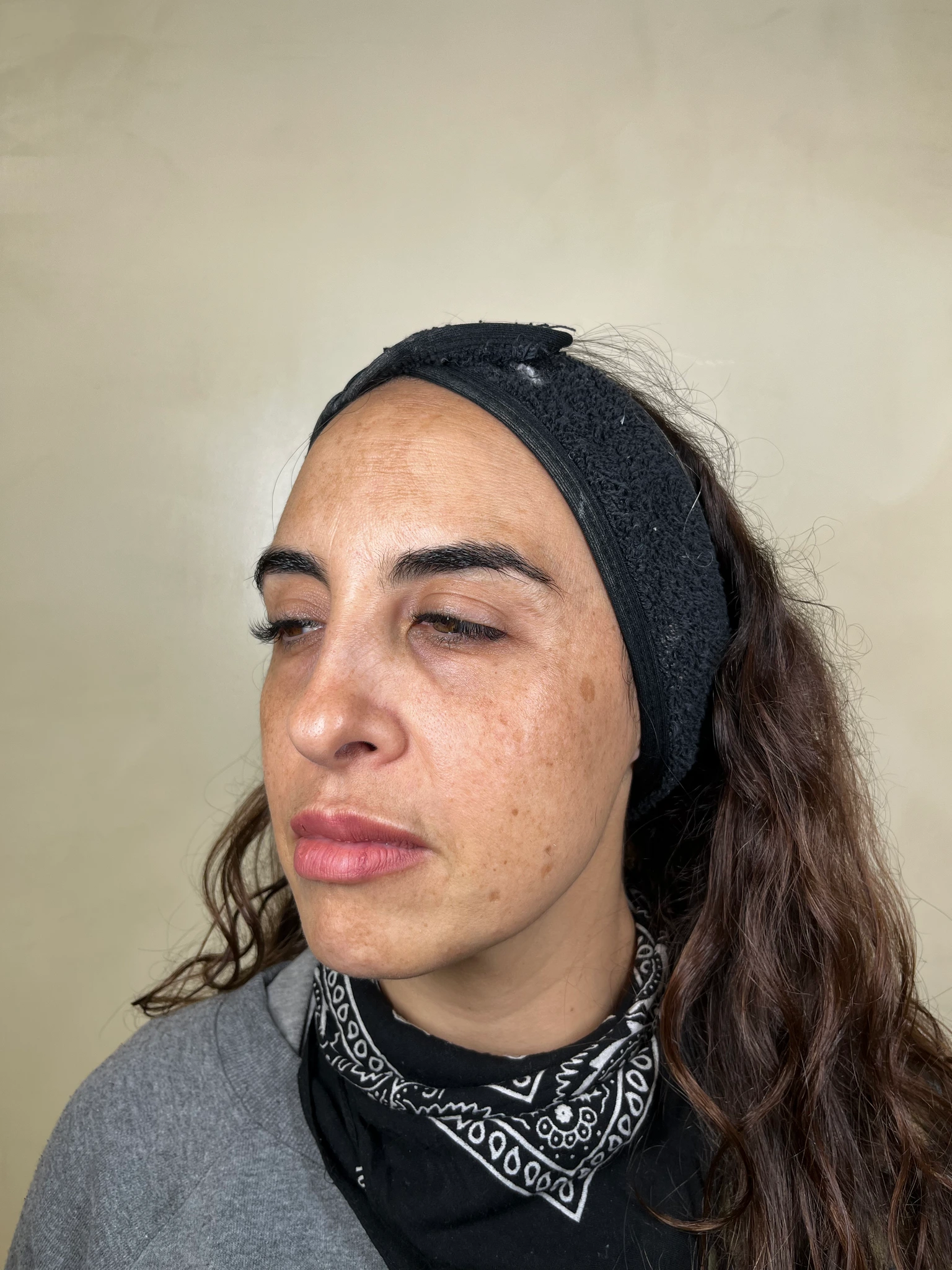 Melasma y Lentigos Solares