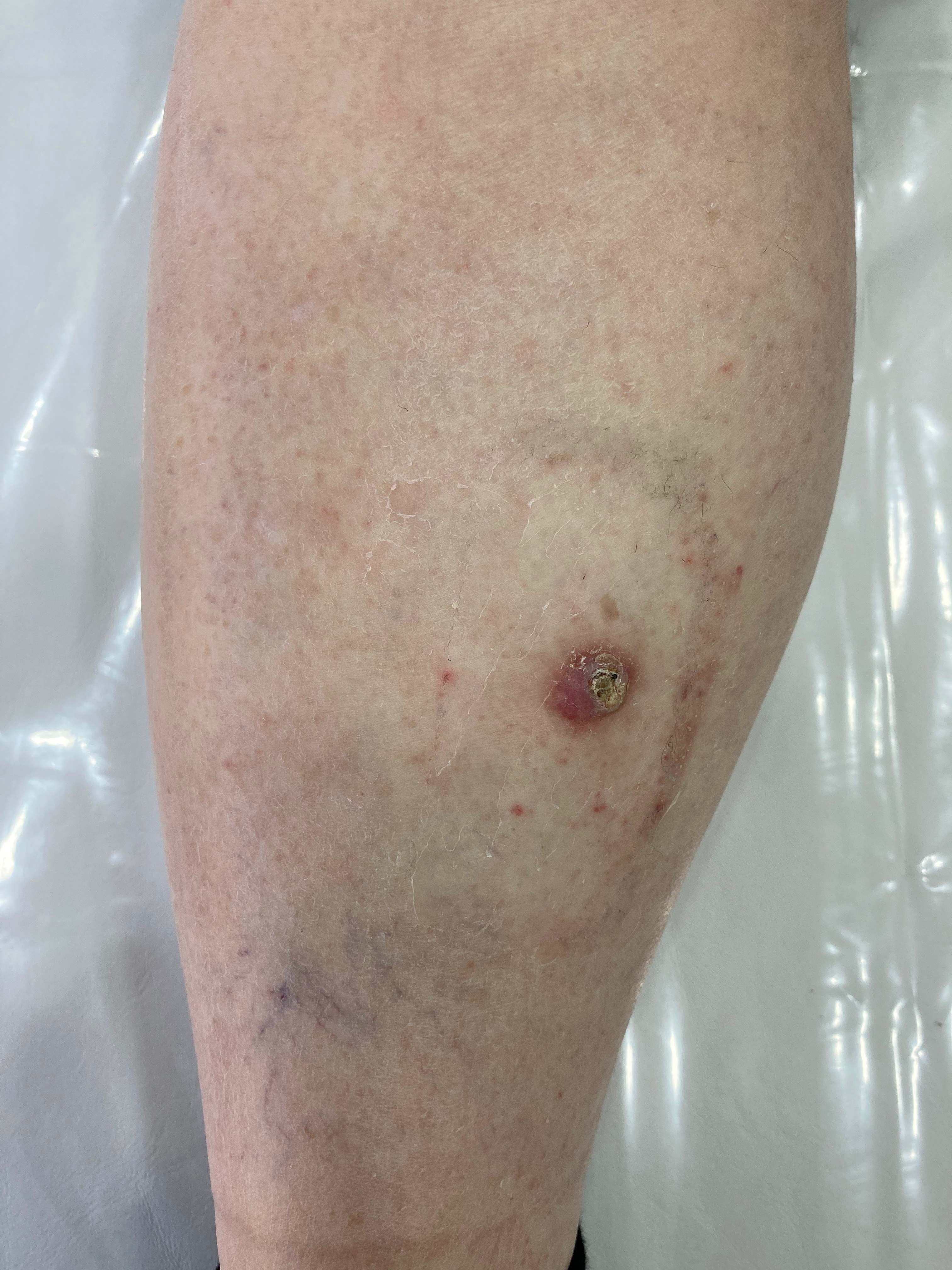Carcinoma Espinocelular (CEC)