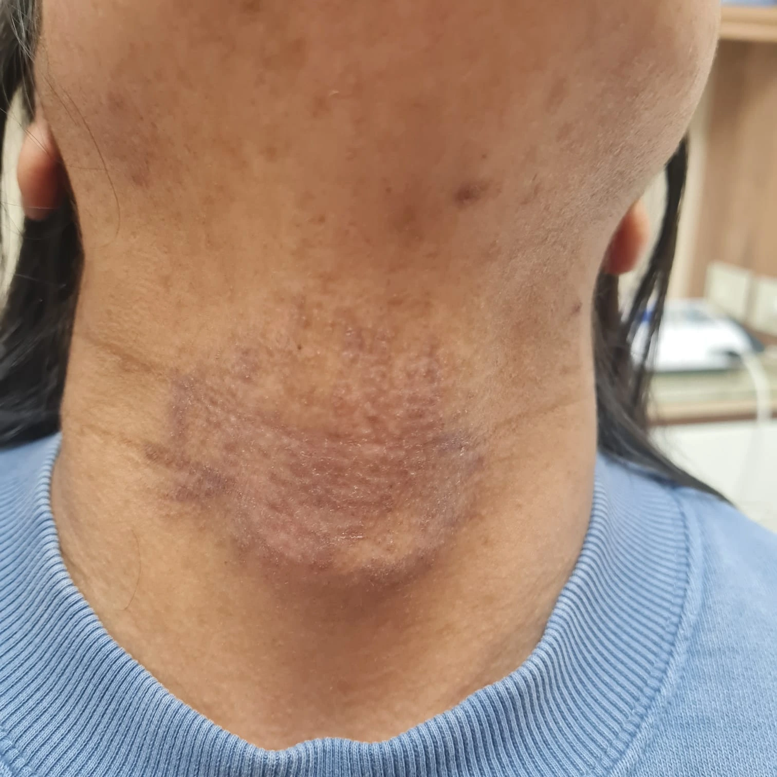Eccema de contacto