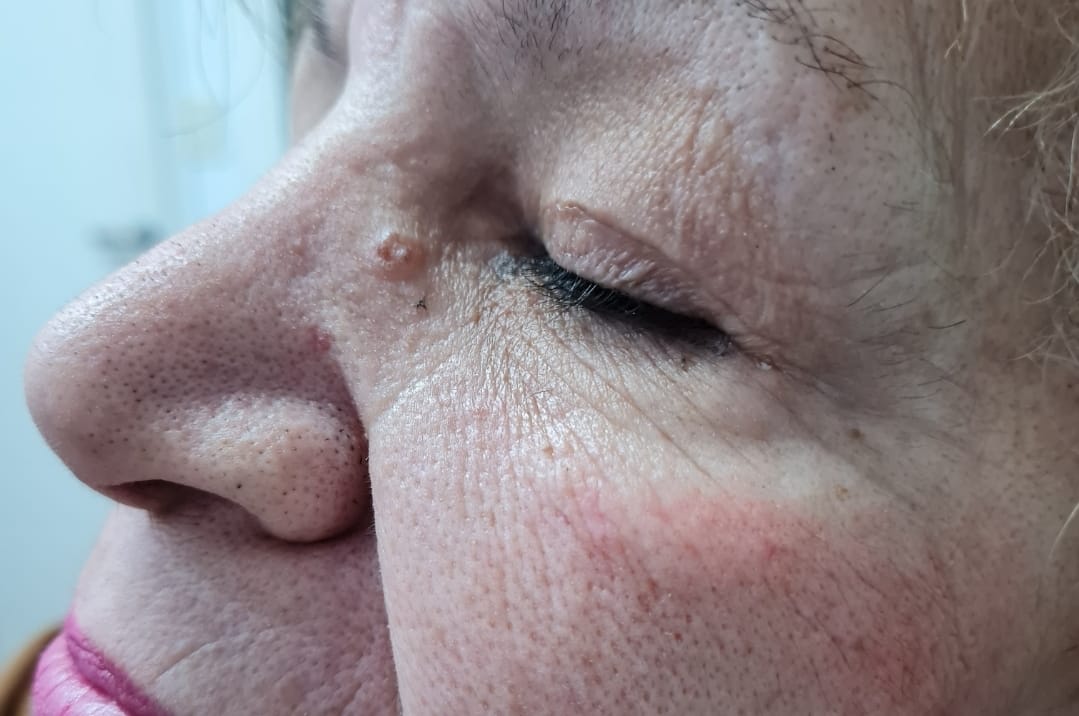 Carcinoma Basocelular