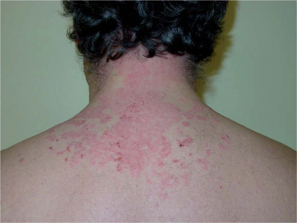 Psoriasis • Cuero Cabelludo y dorso